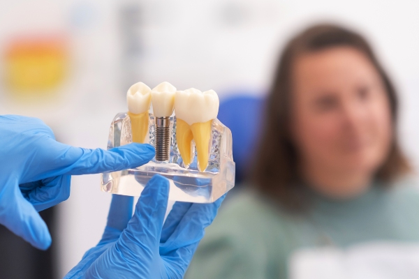 Questions To Ask Your Implant Dentist