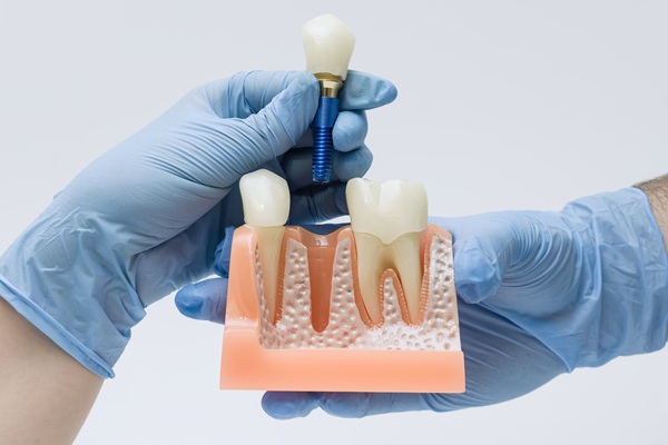 How To Know You Are A Candidate For Dental Implants